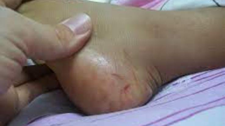 44-year-old woman dies of snake bite in Kholi