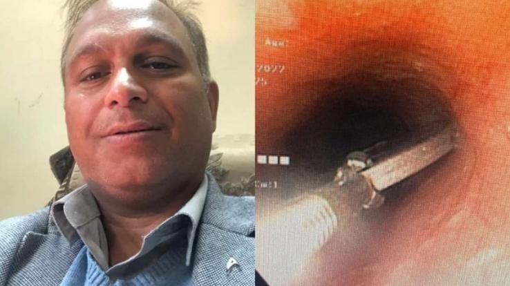 Dr. Prem Bhardwaj took out the coin stuck in the girl's neck by endoscopy method