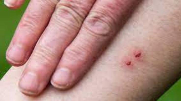 14-year-old girl dies of snake bite