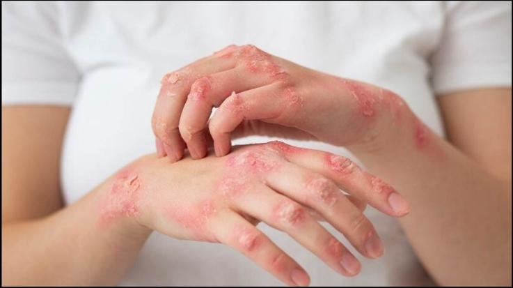 Solan: Auxiliary polling station will be established for leprosy patients.