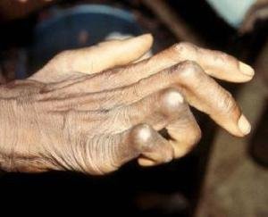 Shimla: National leprosy eradication program being run for leprosy patients in the state