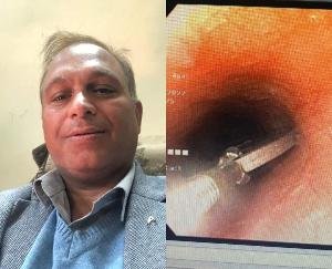 Dr. Prem Bhardwaj took out the coin stuck in the girl's neck by endoscopy method