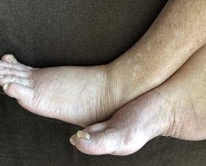 क्षेत्रीय अस्पताल सोलन में होगा क्लब फुट रोगों का निःशुल्क उपचार