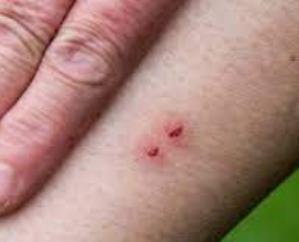 14-year-old girl dies of snake bite